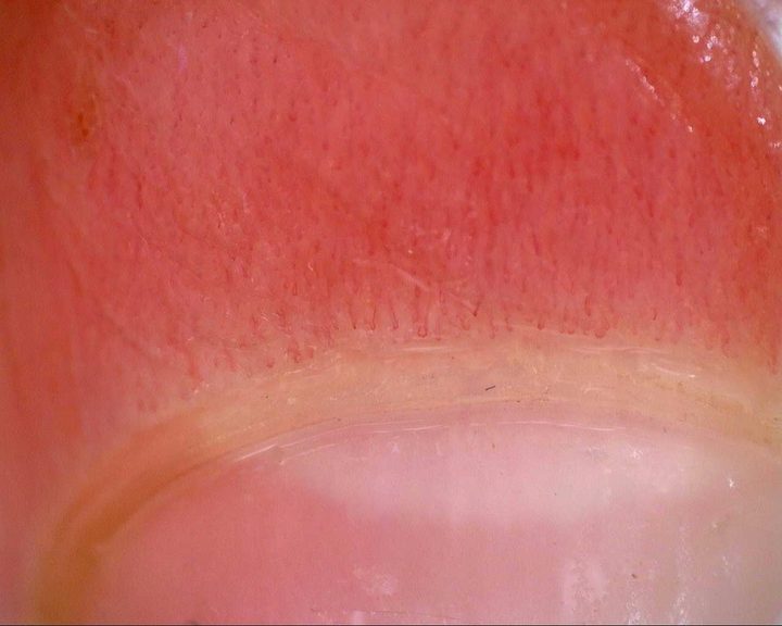 Initial nailfold overview from the longitudinal mixed connective tissue disease case. Use the serial studies to assess change in morphology and density.