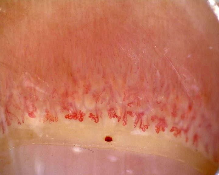 An overview of the nailfold from the anti-Mi2β dermatomyositis case. This wider view provides context; use the complete study for calibrated measurements and individual capillary assessment.