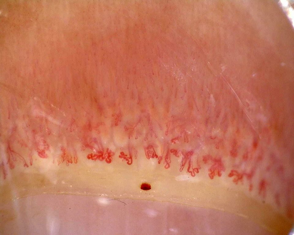 Imagen de vista previa de Dermatomiositis anti-Mi2β en fase activa