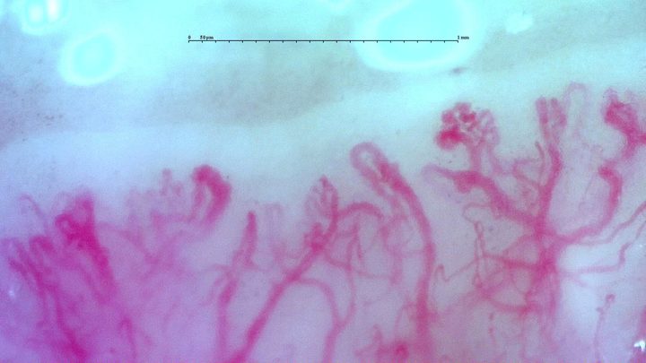 Complex, winding and ramified vascular forms in the anti-TIF1γ dermatomyositis case. A scleroderma-like image appearance does not establish systemic sclerosis.