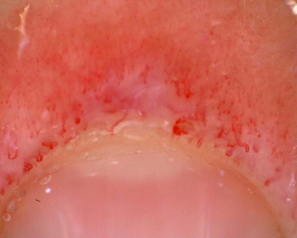 Imagen de vista previa de Dermatomiositis juvenil anti-TIF1 con patrón esclerodermiforme like activo