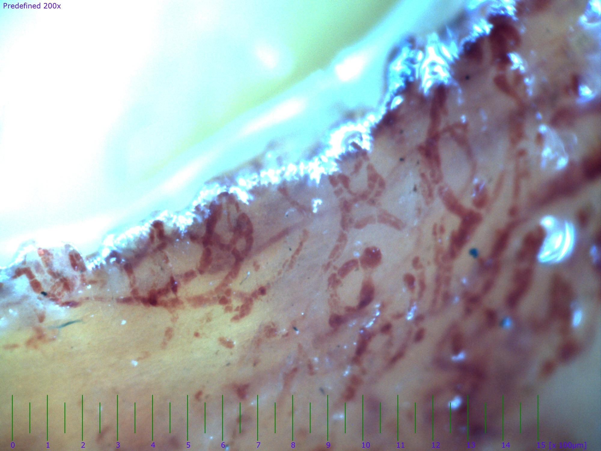 Campo capilaroscópico de un dedo con isquemia crítica y trombosis capilar difusa