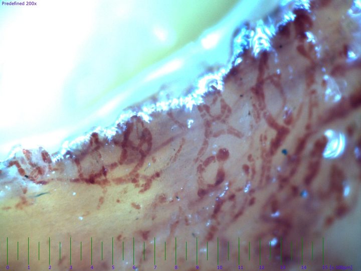 Campo capilaroscópico de un dedo con isquemia crítica y trombosis capilar difusa