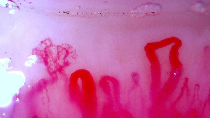 Prominent enlarged loops and a complex branching form in the initial anti-NXP2 dermatomyositis study. Compare this with the linked follow-up image and complete serial studies.