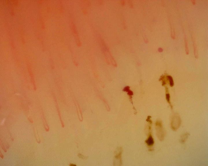 Depósitos hemorrágicos oscuros junto a asas capilares en el estudio inespecífico de referencia. La hemorragia aislada no define un patrón esclerodermiforme.