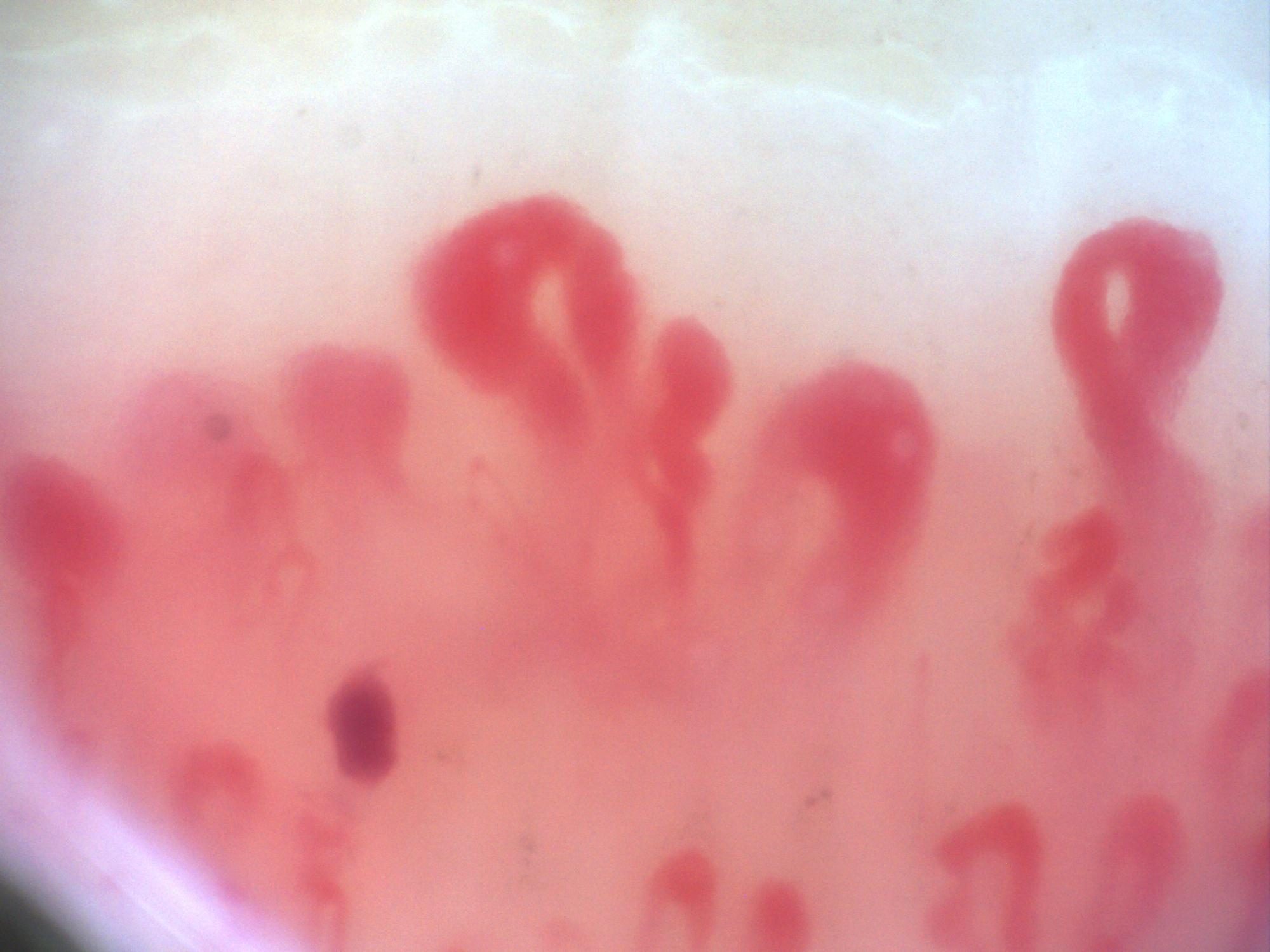 Campo de capilaroscopia 200x con megacapilares de gran tamaño en un patrón esclerodermiforme activo