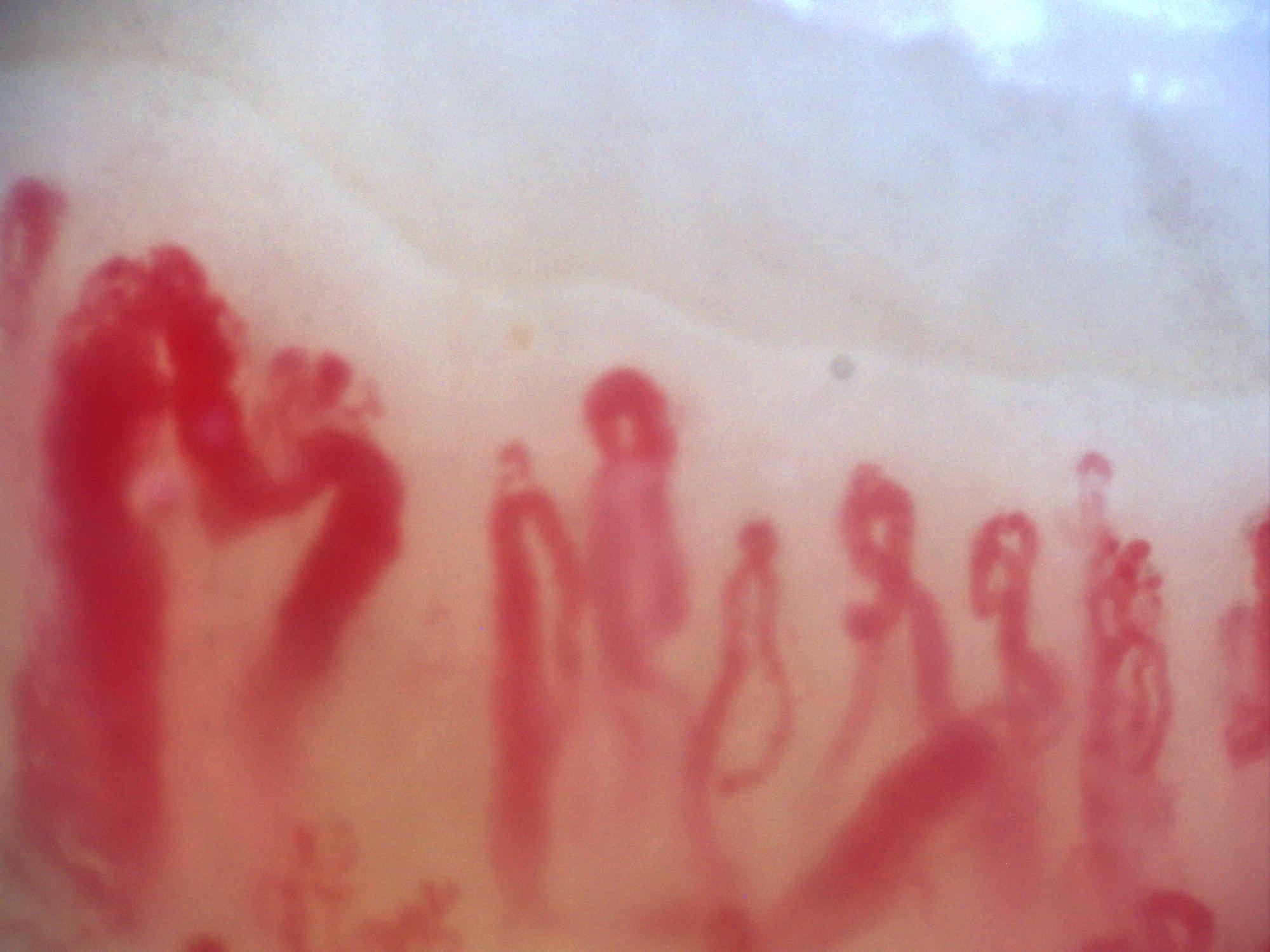 Campo de capilaroscopia 200x con varios megacapilares sobre un patrón esclerodermiforme activo
