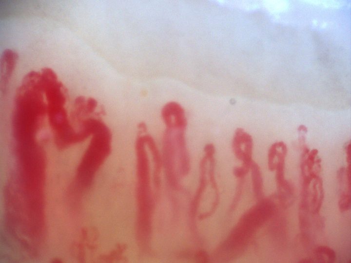 Campo de capilaroscopia 200x con varios megacapilares sobre un patrón esclerodermiforme activo