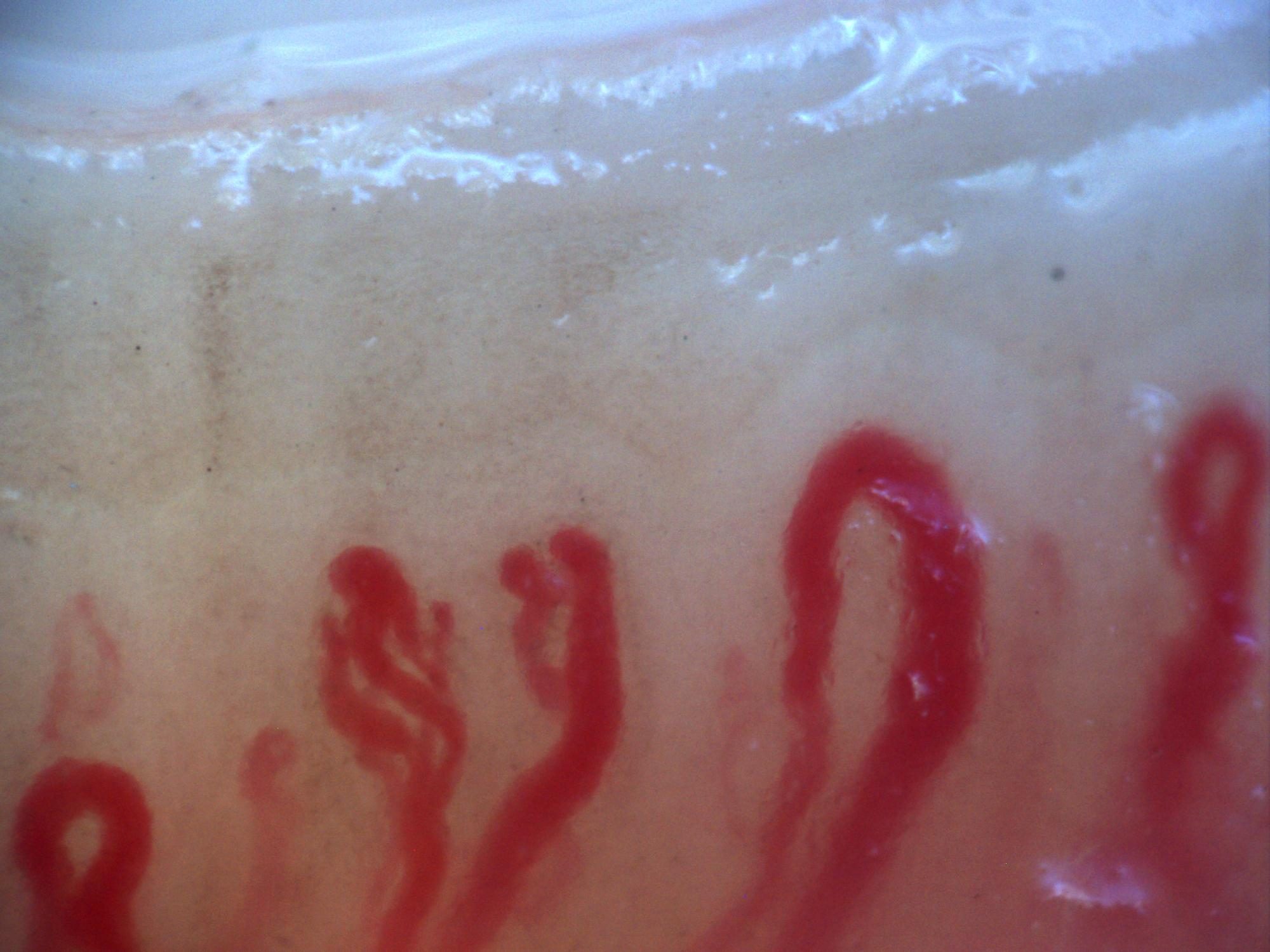 Campo de capilaroscopia 200x con megacapilares prominentes sobre un patrón esclerodermiforme activo