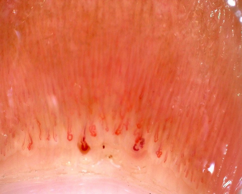 Imagen de vista previa de Dermatomiositis juvenil con lesiones de Gottron y patrón esclerodermiforme like