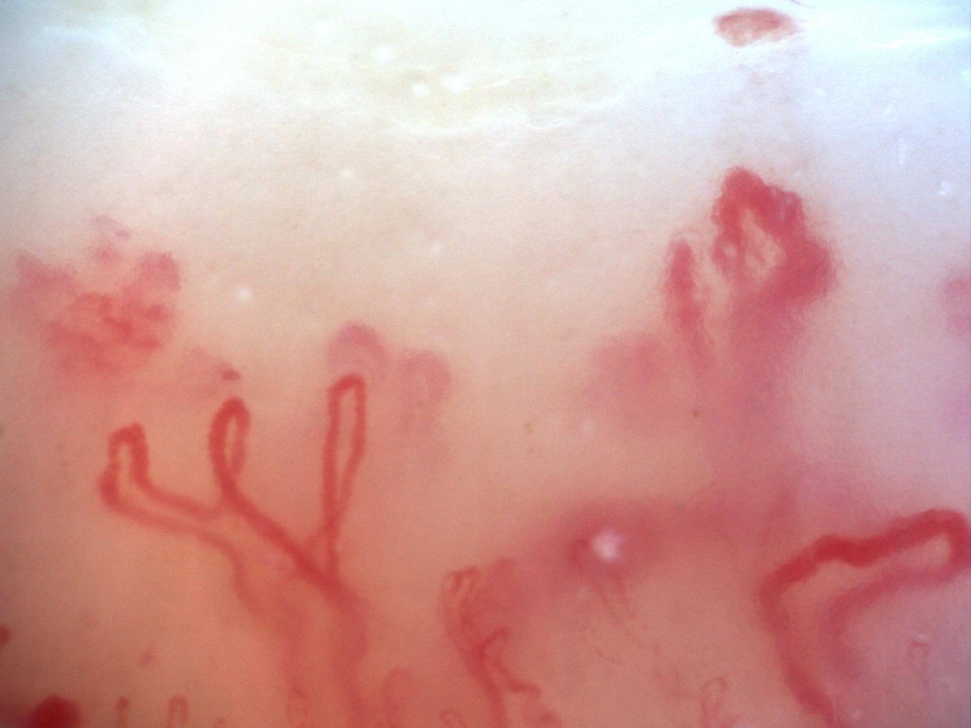 Campo de capilaroscopia 200x con niebla pericapilar entre los capilares compatible con edema pericapilar