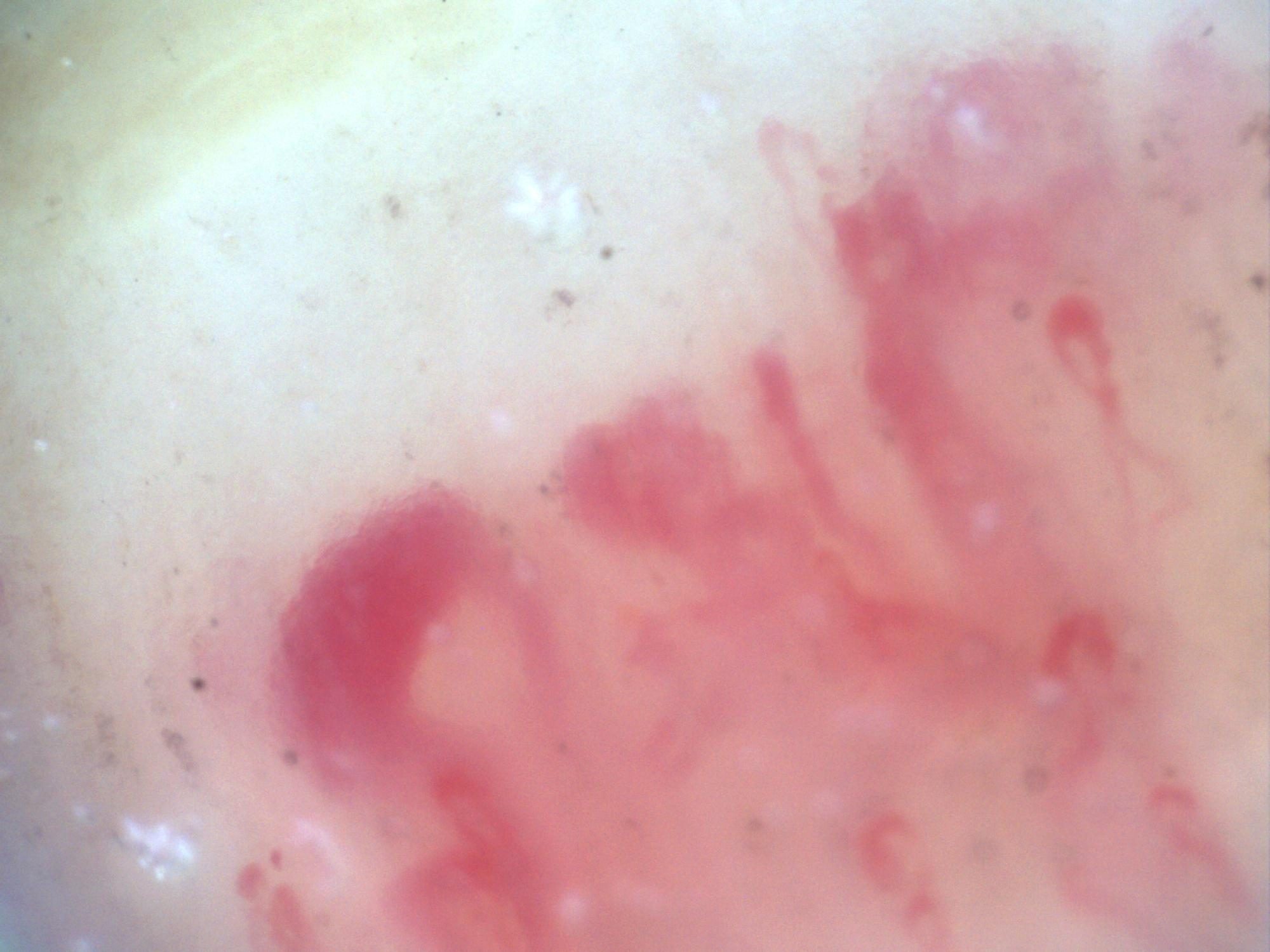 Campo de capilaroscopia 200x en esclerosis sistémica con megacapilares y patrón en vidrio esmerilado sugestivo de fibrosis
