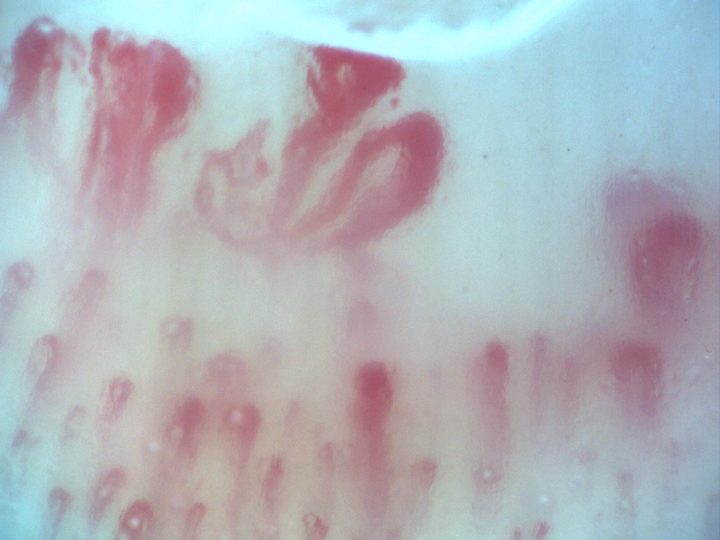 Campo de capilaroscopia 200x en esclerosis sistémica con megacapilares, edema pericapilar y patrón en vidrio esmerilado