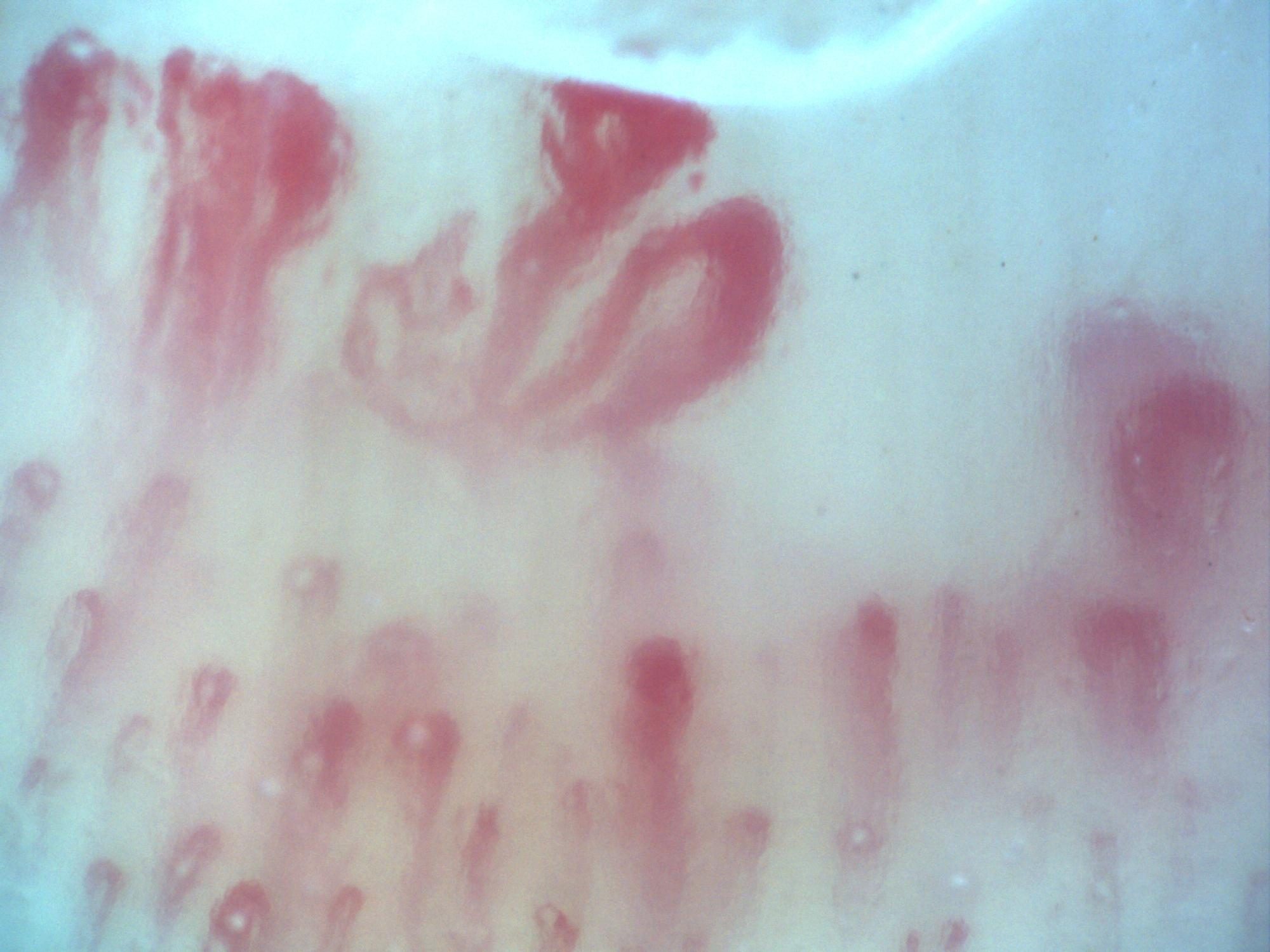 Campo de capilaroscopia 200x en esclerosis sistémica con megacapilares, edema pericapilar y patrón en vidrio esmerilado