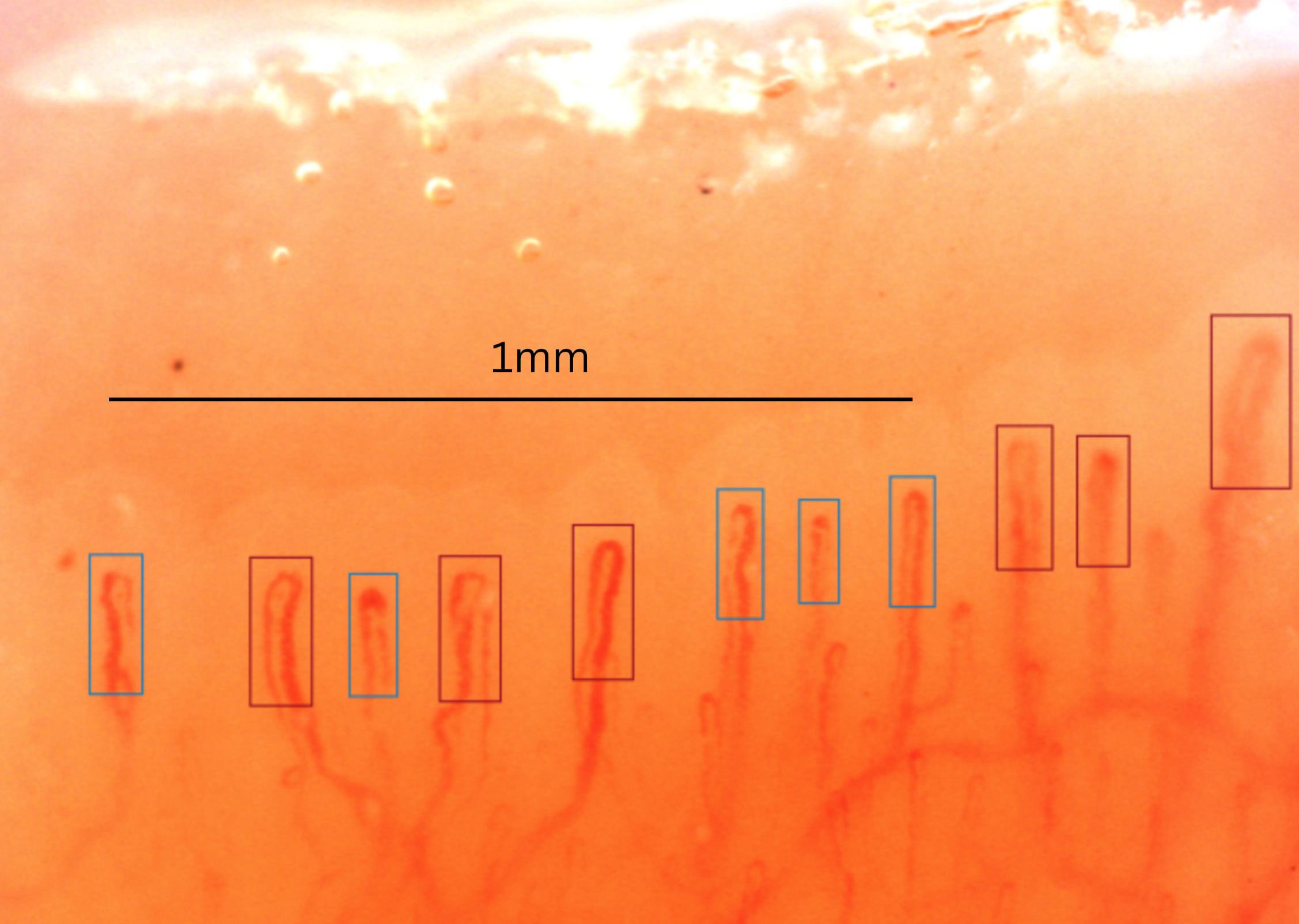 Example of classical semi-quantitative counting in capillaroscopy.