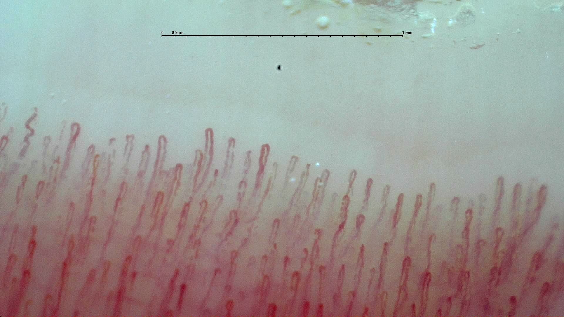 Capilaroscopia periungueal real con una fila de pequeños vasos sanguíneos en forma de asa