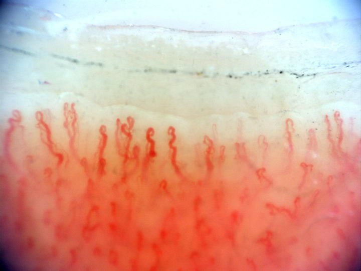Tortuous and branching-appearing capillaries with irregular apices.