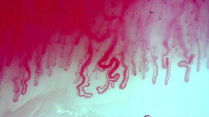 Markedly tortuous and folded capillaries in the center, with narrower hairpins and a small group of multiple loops on the right.