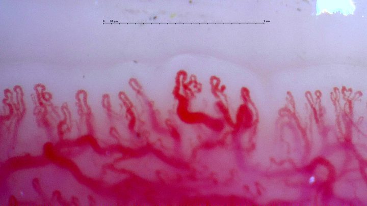 Capilares con múltiples ápices y extremos curvos, sobre una red vascular profunda visible.
