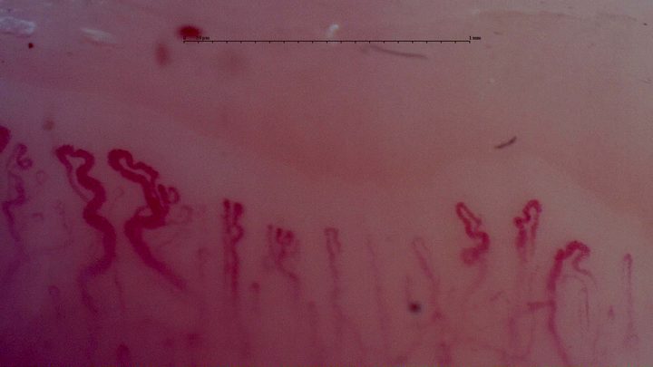 Broad folded capillaries on the left and finer loops on the right. A dark red microhemorrhage lies above the row.