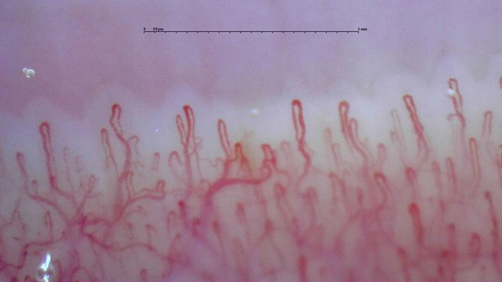 Capilares redondeados en horquilla con algunas ramas curvas o superpuestas. Se ve la red vascular profunda.