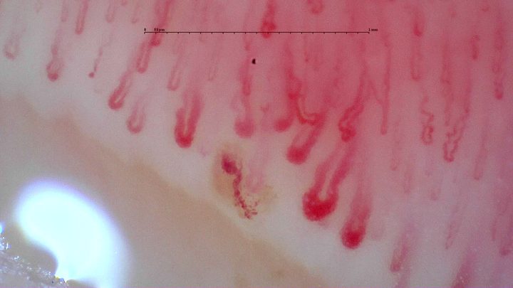Varios capilares de aspecto gigante con ápices redondeados gruesos y ramas curvas. Hay una zona granular pardo rojiza separada cerca de las asas centrales.