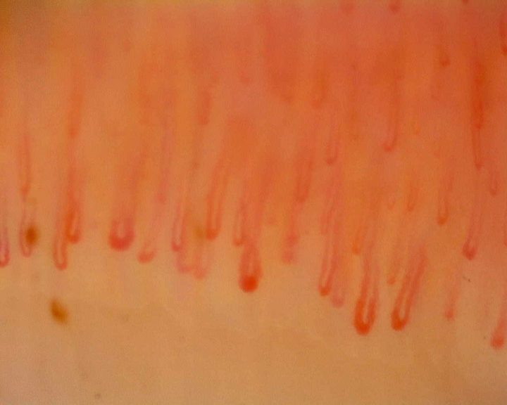Capilares largos en horquilla con algunos ápices redondeados dilatados. Hay pequeños depósitos pardos compatibles con microhemorragias cerca del extremo inferior izquierdo.