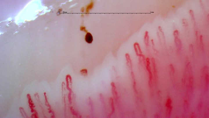 Capillaries with rounded apices and tortuous limbs. An elongated hemorrhagic deposit and smaller brown foci lie above the row.