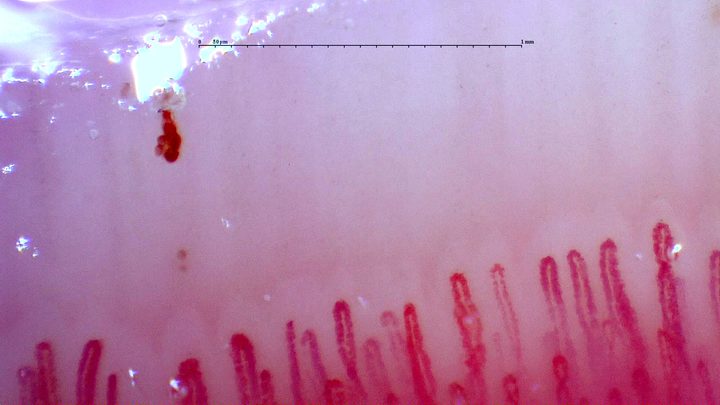 Capilares finos y muy dilatados, algunos parcialmente ocultos. Hay un depósito hemorrágico oscuro alargado sobre el lado izquierdo.