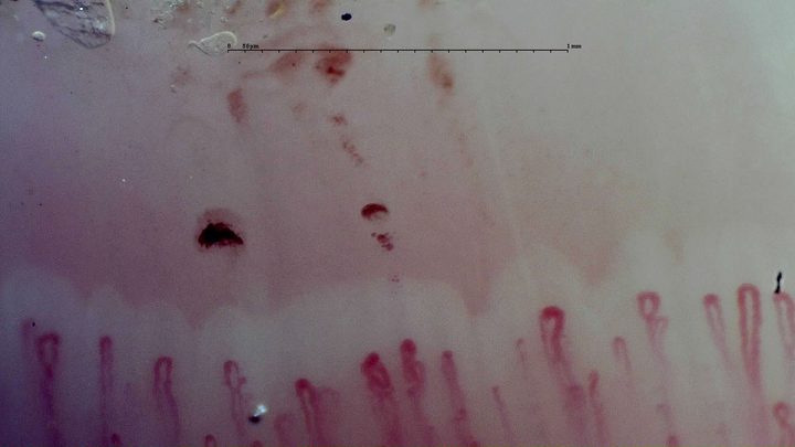 Capilares con ápices redondeados dilatados y algunas asas replegadas. Hay varios depósitos hemorrágicos oscuros y rojo pálidos por encima.