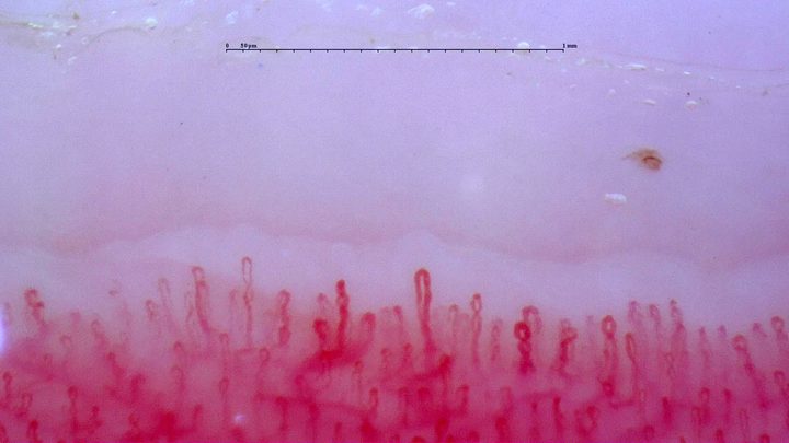 Asas cortas con algunos ápices enrollados y un plexo profundo visible. Un pequeño depósito pardo sobre el lado derecho podría ser una microhemorragia.