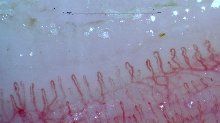 Capilares mayoritariamente finos en horquilla con curvaturas leves en las ramas y un plexo vascular profundo visible.