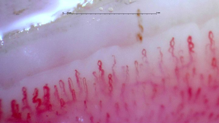 Coiled apices, simple hairpin loops and broad tortuous capillaries. An elongated brown hemorrhagic deposit lies above the center-right.