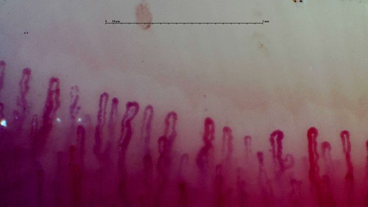 Enlarged capillaries with rounded apices and tortuous limbs. A faint brown mark lies above the center.