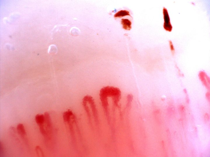 Varios capilares de aspecto gigante con ápices anchos redondeados o angulados. Hay depósitos hemorrágicos oscuros densos por encima.