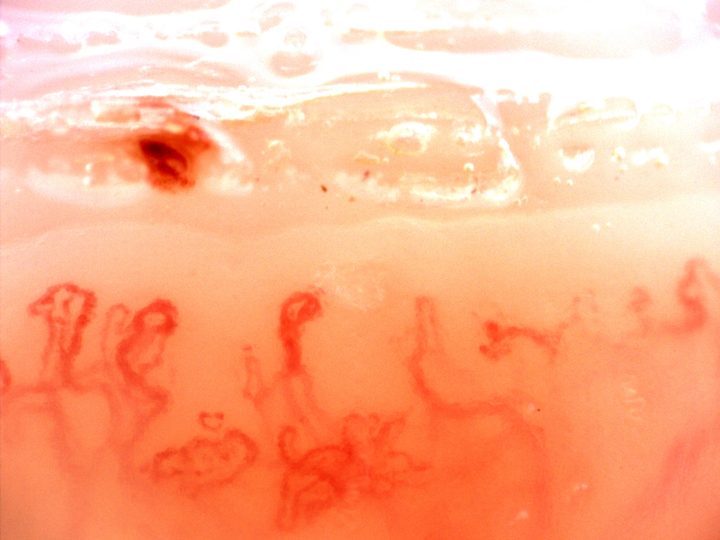 Pequeños capilares ramificados y asas anchas replegadas, con una microhemorragia rojo oscura separada sobre la fila.