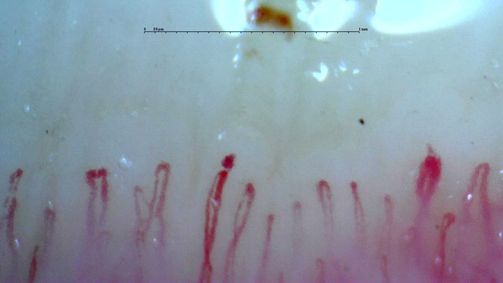 An oval giant-appearing capillary on the right and interrupted contours in some central apices. A separate brown hemorrhagic deposit lies above the row.