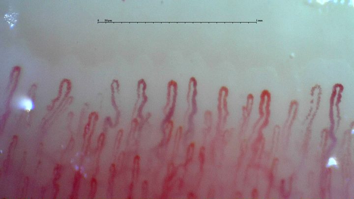 Capillaries with enlarged rounded apices and mildly tortuous limbs, mixed with smaller hairpin loops.