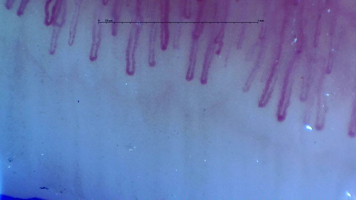 Long, broad hairpin capillaries with mostly parallel limbs and variable apical widths.