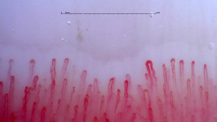 An enlarged hairpin capillary right of center, with finer neighboring loops and occasional curved limbs.