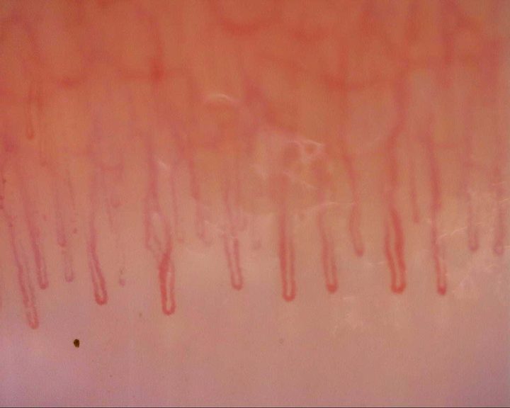 Long hairpin capillaries with broad U-shaped apices and mostly parallel limbs. A reflection obscures part of the central limbs.
