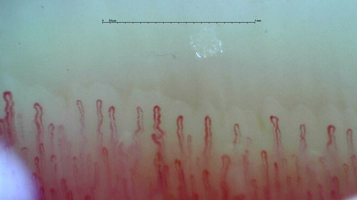 Mostly narrow hairpin capillaries with mild bends in some limbs, including a small central kink.