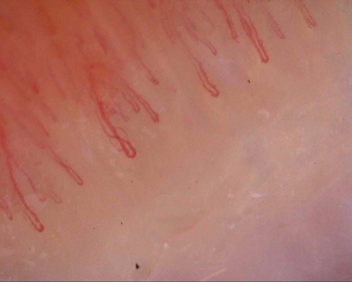 Un capilar alargado con una rama curva, entre asas más finas en horquilla con ápices redondeados.
