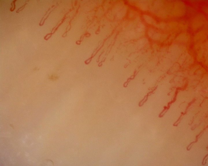 Fine crossed and curved capillaries mixed with long straight hairpin loops. The deeper vascular network is visible.