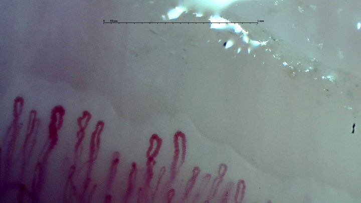 An enlarged rounded apex on the left and an oval crossed loop near the center, among narrower hairpin capillaries.