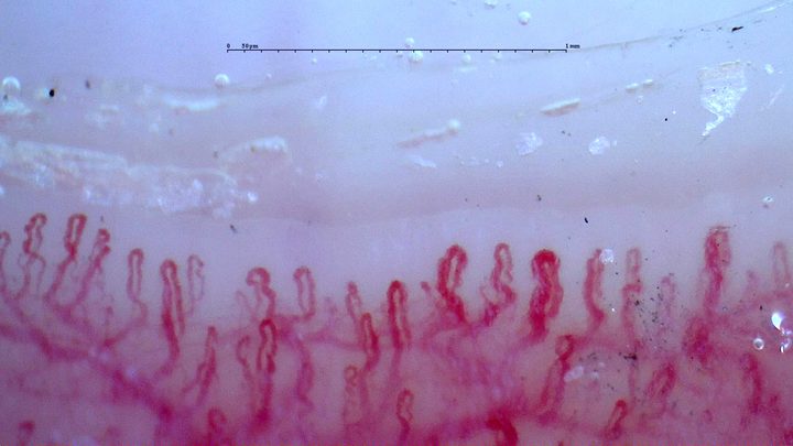 Numerosos capilares cortos y tortuosos, con asas más gruesas cerca del centro derecho y una red vascular profunda visible.