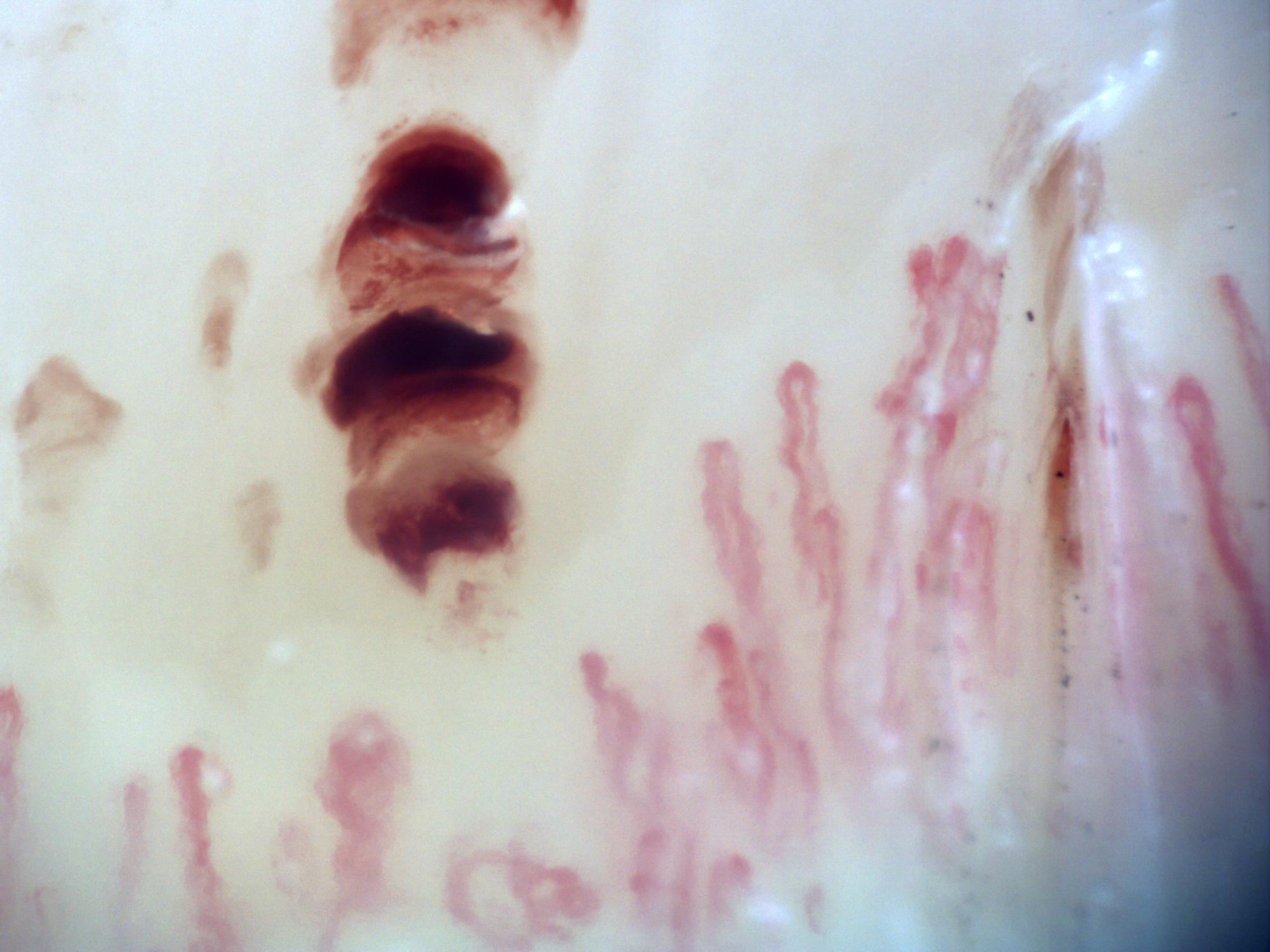 Campo de capilaroscopia 200x en esclerosis sistémica con una lesión hemorrágica