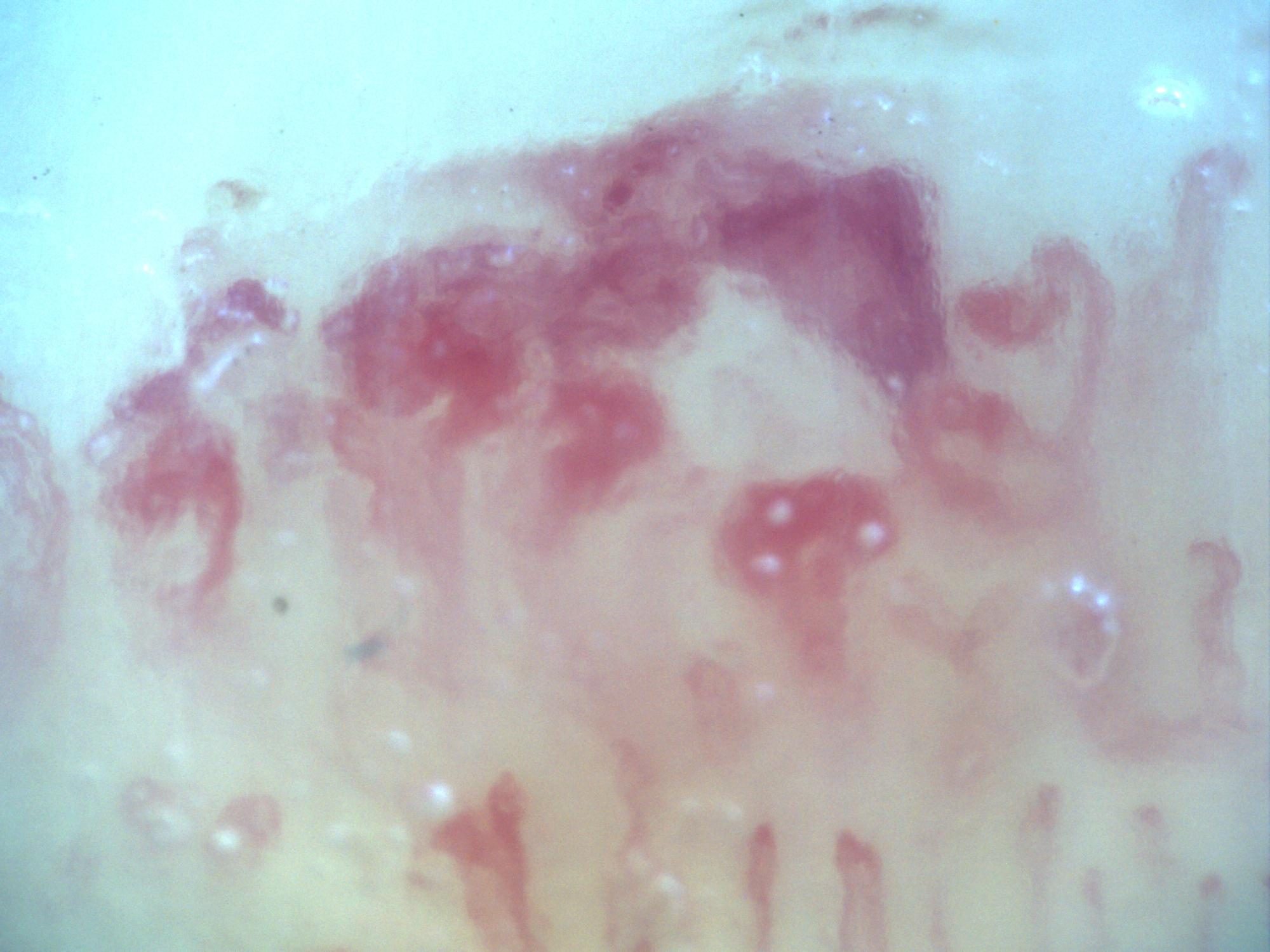 Campo de capilaroscopia 200x en esclerosis sistémica con hemorragia de aspecto en fumarola