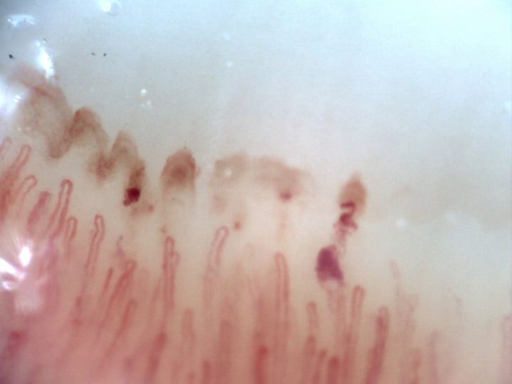 Videocapilaroscopia periungueal del cuarto dedo derecho con densidad capilar conservada, hemorragias y ausencia de capilares gigantes