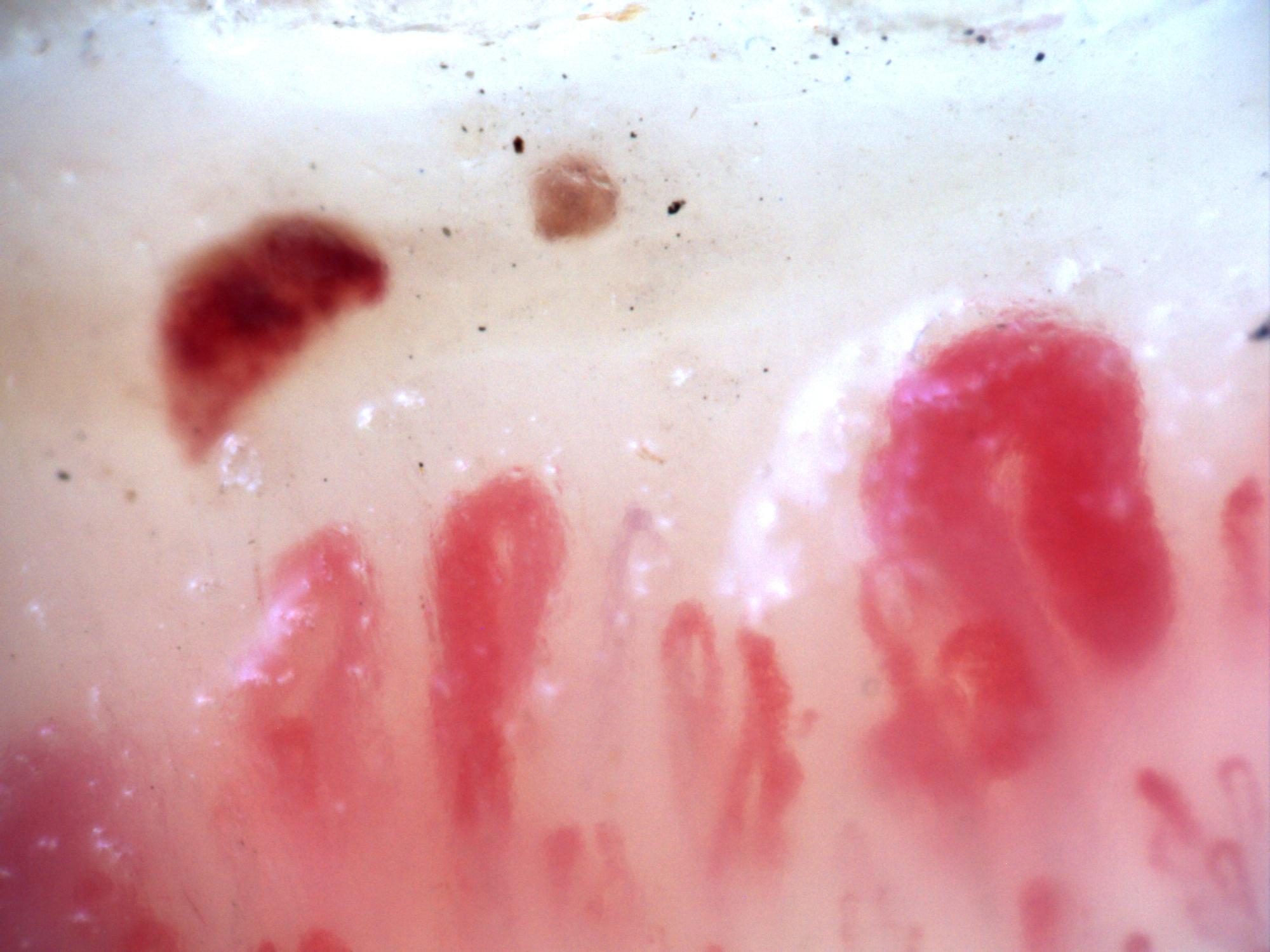 Campo de capilaroscopia 200x en esclerosis sistémica con un megacapilar prominente